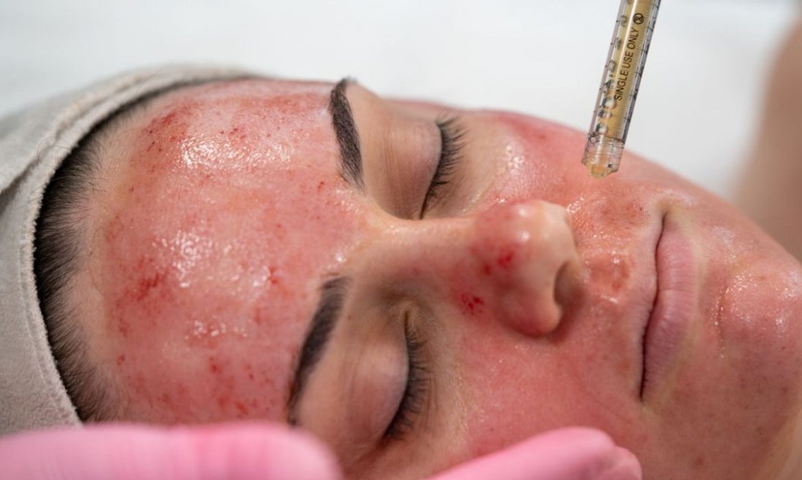 Microneedling with PRP > Perfect Touch MedSpa